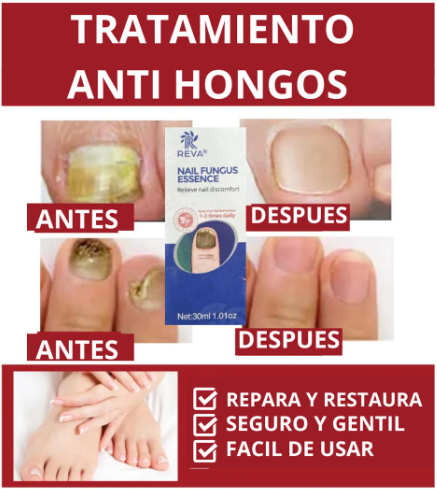 SERUM ANTI HONGOS NAIL FUNGUS